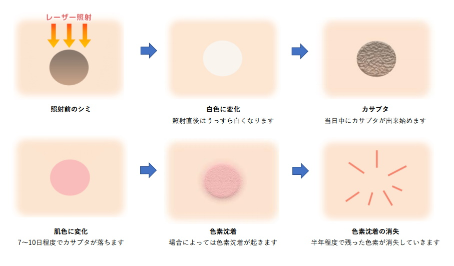 炎症後色素沈着